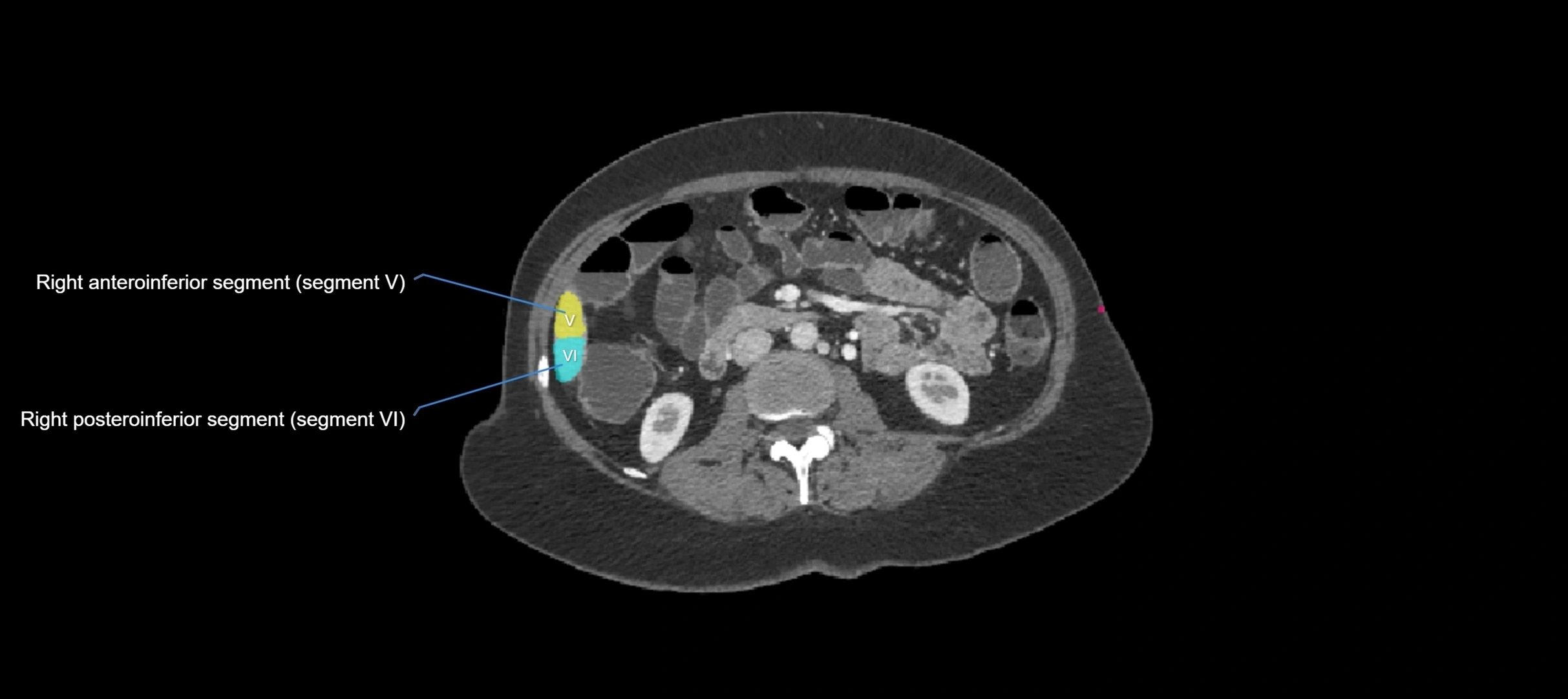 CT liver segments axial cross sectional anatomy labelled image-00006.webp